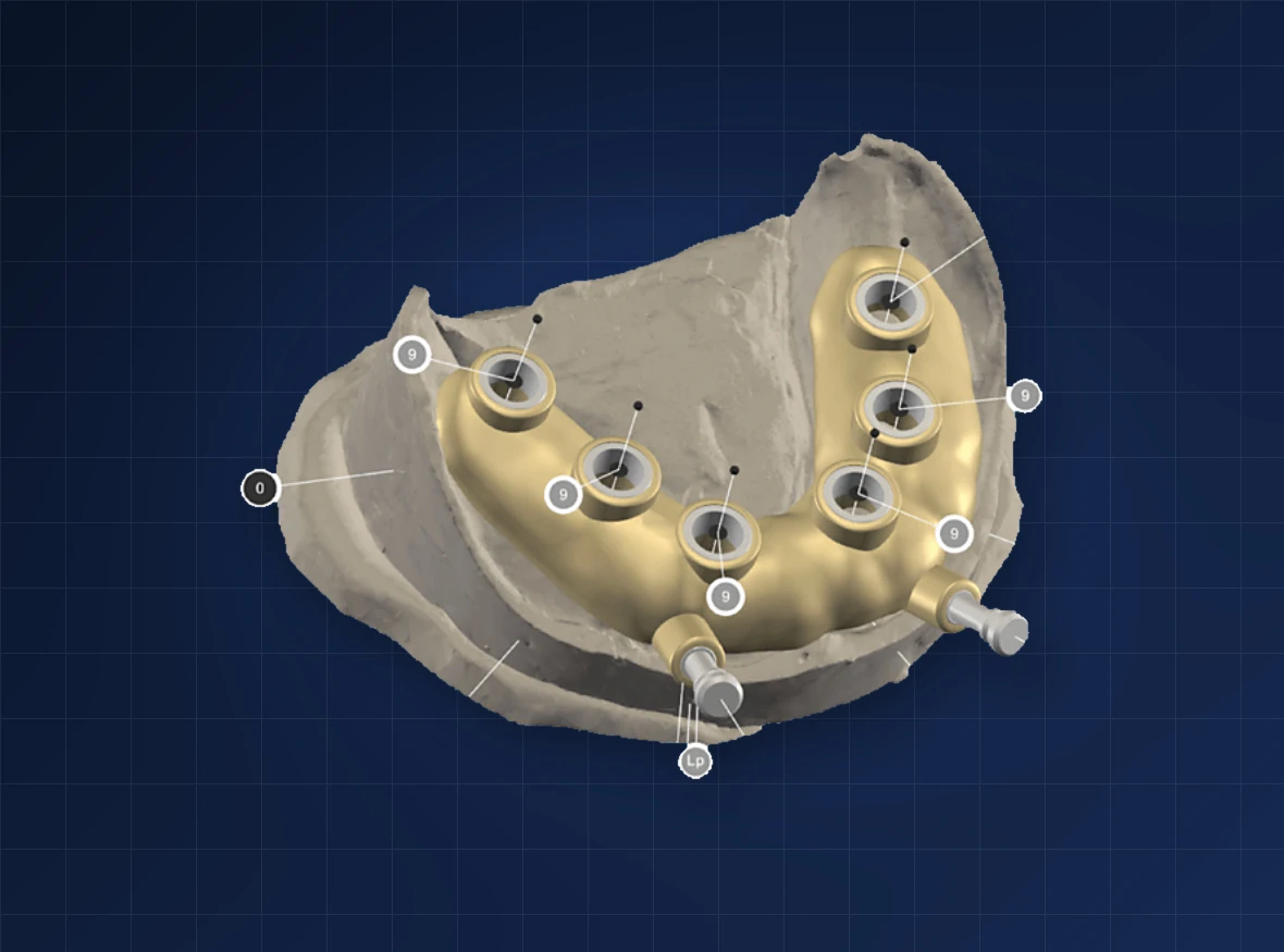 A printed surgical guide seated on an arch model, with the drill sleeves in place
