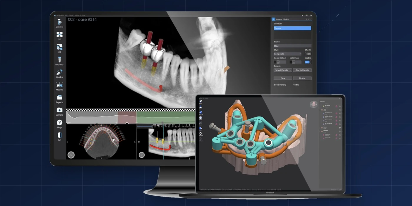 Implant 3D planning software — a CBCT with implants placed, and a stackable guide in Implant 3D Sculpt