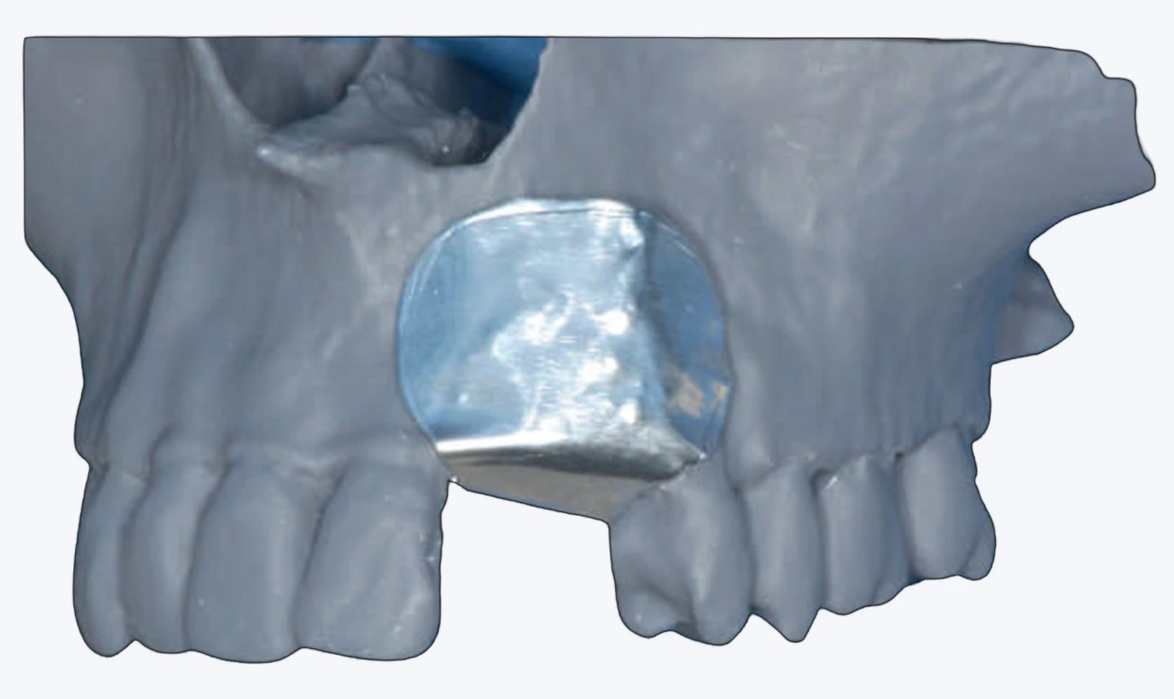 A shaped bone graft seated against the maxilla in the position the planned fixtures need