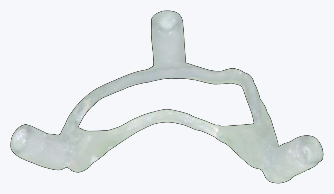 A printed reduction guide, its rails setting the crestal level the prosthesis was planned to sit at