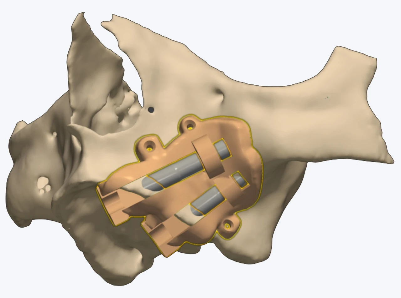 A zygomatic surgical guide seated on the segmented bone, its sleeves holding both trajectories towards the zygomatic body